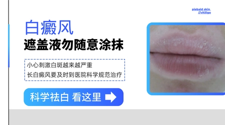 用遮瑕膏盖白斑对病情有影响吗