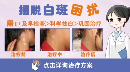 用遮瑕膏盖白斑对病情有影响吗