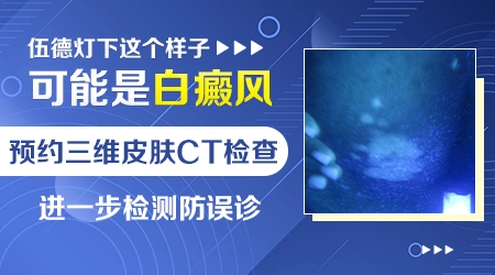 白斑在伍德灯下显示什么颜色是白癜风