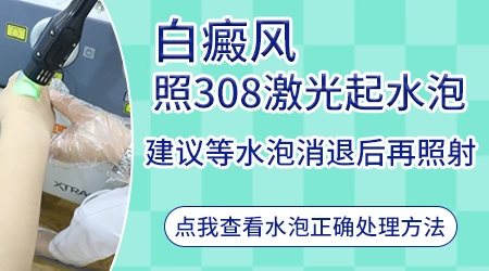 白斑光疗之后皮肤起泡该怎么处理