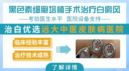 黑色素细胞移植治疗白斑效果如何