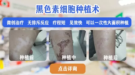 黑色素细胞移植治疗白斑效果如何