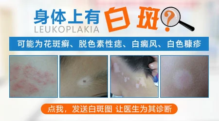 身上长白斑但没有感觉会是什么病
