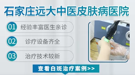 石家庄哪个中医看白癜风有名
