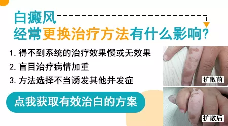 白癜风治疗中途换方案会影响效果吗