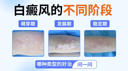 白癜风不同阶段颜色变化过程图
