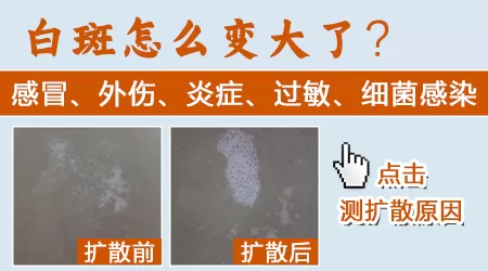 白癜风又出现皮炎会诱发新的白斑吗