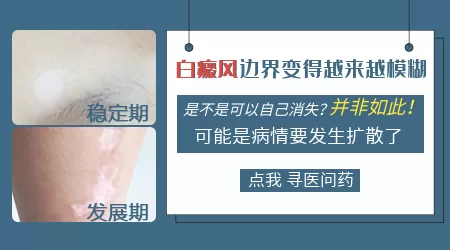 白癜风白斑边界变模糊说明什么