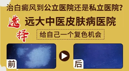 石家庄看白癜风要选公立还是私立医院