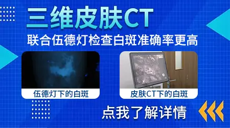 白癜风早期症状图片带讲解 新手也能快速识别早期白斑