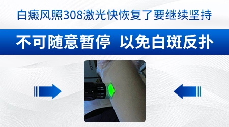 不同品牌的308光疗仪照白癜风效果有区别吗