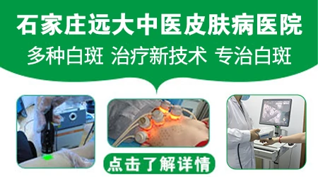 石家庄治白斑的医院哪家设备更齐全