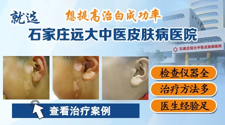 石家庄治白斑的医院哪家设备更齐全