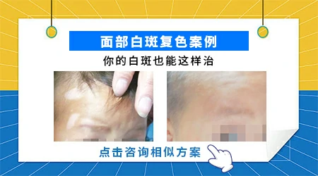 面部白癜风用308光疗效果好不好