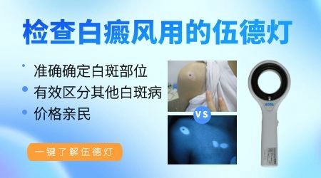 伍德灯测出白癜风误诊率多少
