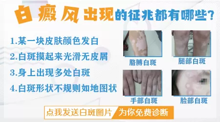 膝盖内侧白癜风最初征兆图片
