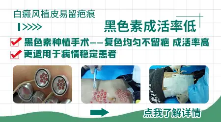 植皮手术治疗白癜风成功率大概有多少