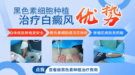 植皮手术治疗白癜风成功率大概有多少