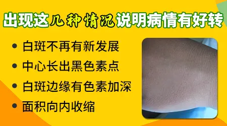 白癜风窄谱UVB光疗在家自己做安全吗