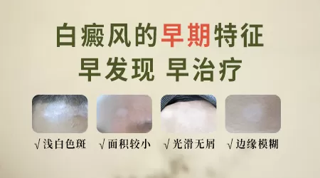 皮肤上的小白点会不会是白癜风的前兆