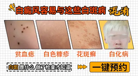 手背手腕白癜风最初征兆图片