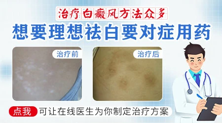 白癜风种植和308光疗哪个效果更好