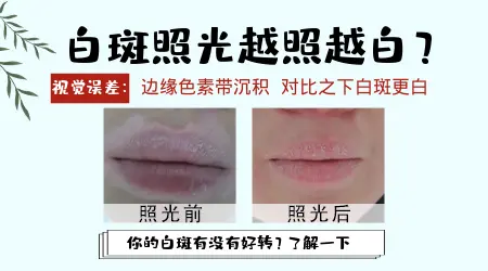 白癜风为什么会越治越白