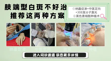 多年肢端型白癜风特效药推荐