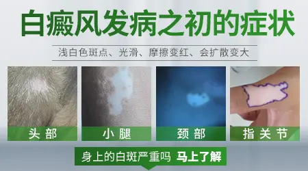 早期白癜风和普通白斑怎么肉眼分辨