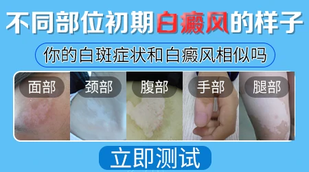 白癜风刚开始是什么样子图片大全