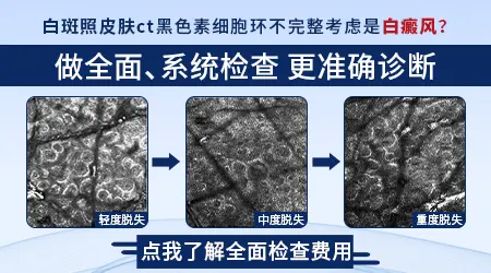 wood灯下白斑显示亮白色病情分析
