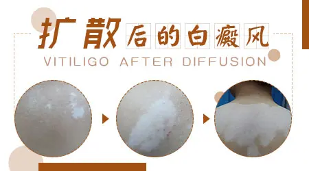 宝宝腿上出现白斑越来越大怎么回事