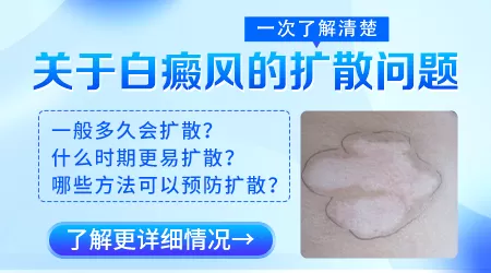 白癜风白斑出现后多久会开始扩散