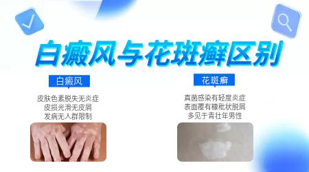 早期白癜风和花斑癣怎么辨别