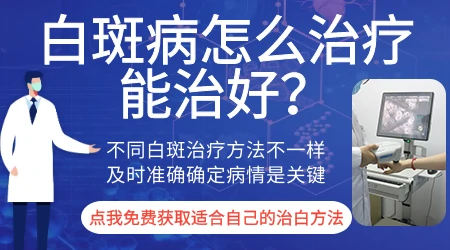 早期白癜风和花斑癣怎么辨别