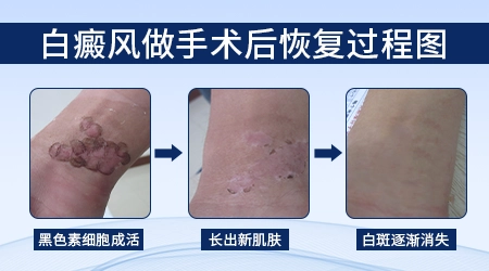手部白癜风有什么好的法子治好