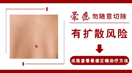 晕痣切除是只切痣还是白斑一起切