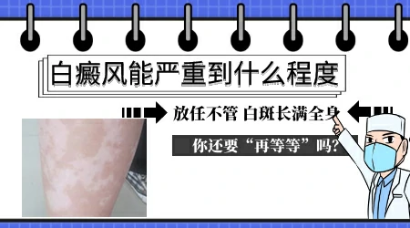 伍德灯下的白斑荧光强代表更严重吗