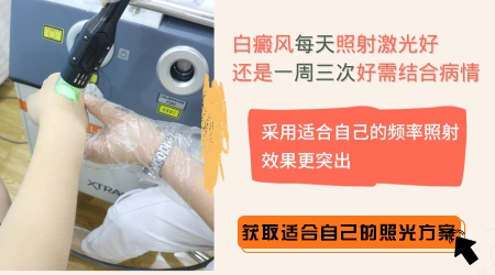 光疗治疗白癜风的频率多少合适