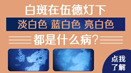 伍德灯呈亮蓝白色肯定是白癜风吗