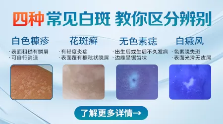 白癜风和其他白斑的图片区别