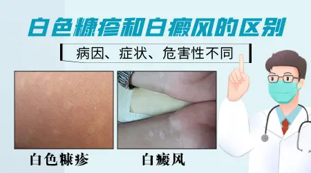 面部白斑图片白色糠疹和白癜风对照