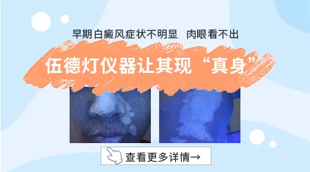 皮肤刚长白癜风时什么样图片