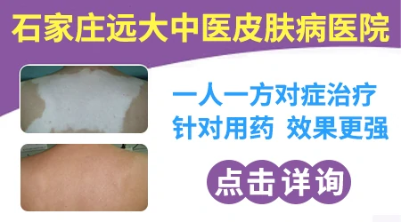 皮肤白斑在石家庄找哪个医生看更靠谱