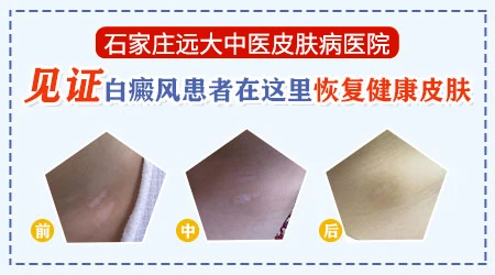 皮肤白斑在石家庄找哪个医生看更靠谱