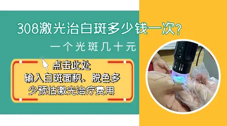 脸上有白斑照射308激光一次要多少钱