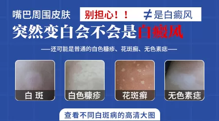嘴巴外面有一圈泛白怎么回事