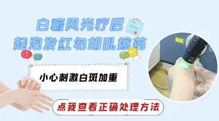 白癜风光疗之后皮肤出现发红起泡怎么处理