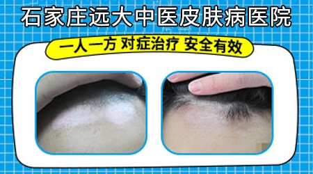 色素减退白斑和白癜风怎么区分