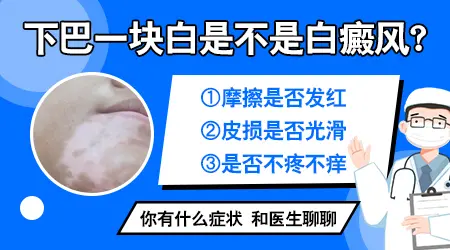 下巴长淡白色白癜风初期图片